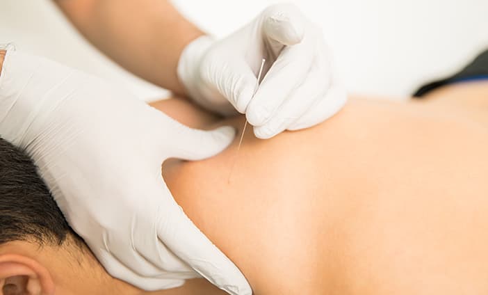 main image Dry Needling